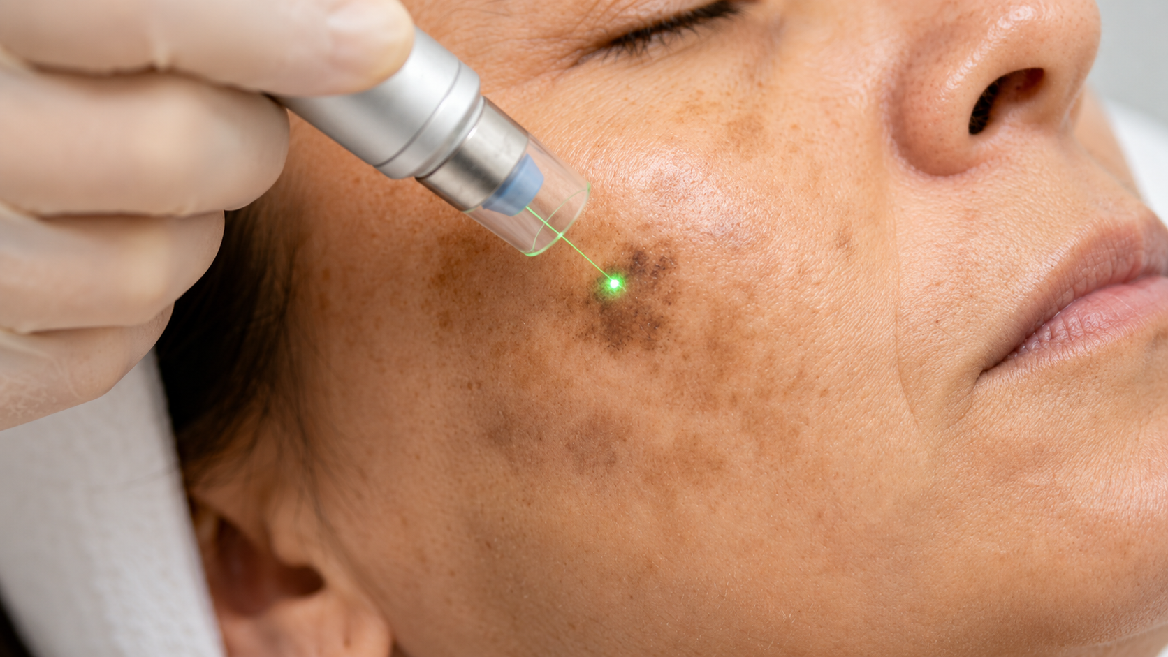 The Science Behind Laser Treatment